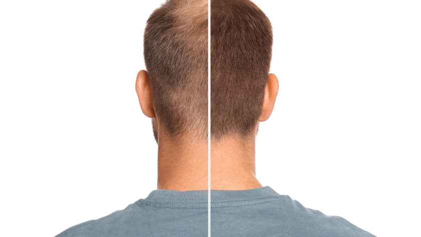 Peptide therapy: Peptides for Hair Restoration and Hair loss cure