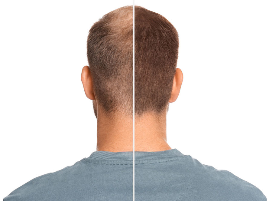 Peptide therapy: Peptides for Hair Restoration and Hair loss cure